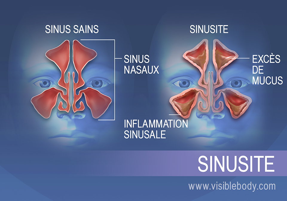 Les sinus des personnes souffrant de sinusite contiennent du mucus en excès et leurs parois sont enflammées